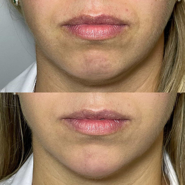 Skin Tone Balancing Peels in Sutton, Surrey