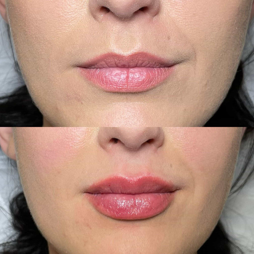 How Long Does Russian Lip Filler Last