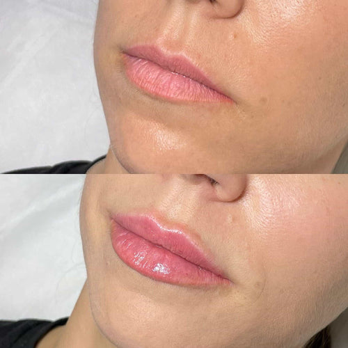 How Long Does Lip Filler Take To Go Down