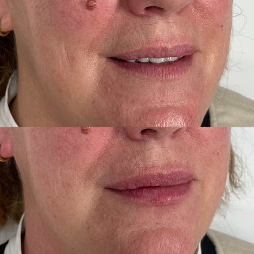 Can Botox Improve Nasolabial Folds? What You Should Know