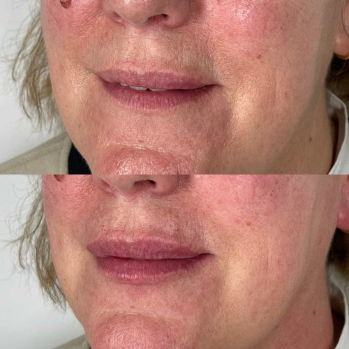 Can Botox Improve Nasolabial Folds? What You Should Know