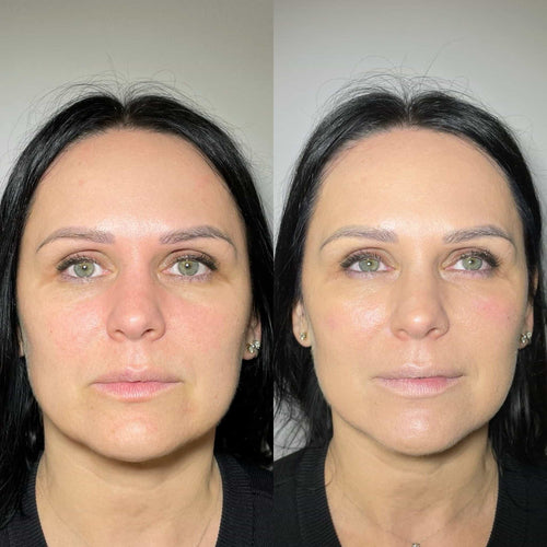 How To Fix Migrated Lip Filler