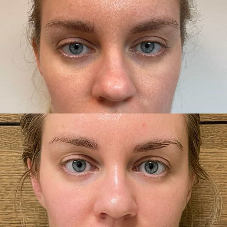 Skin Tone Balancing Peels in Sutton, Surrey